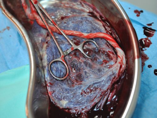 třetí doba porodní - placenta třetí doba porodní - placenta